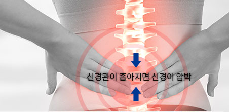 협착증 원인